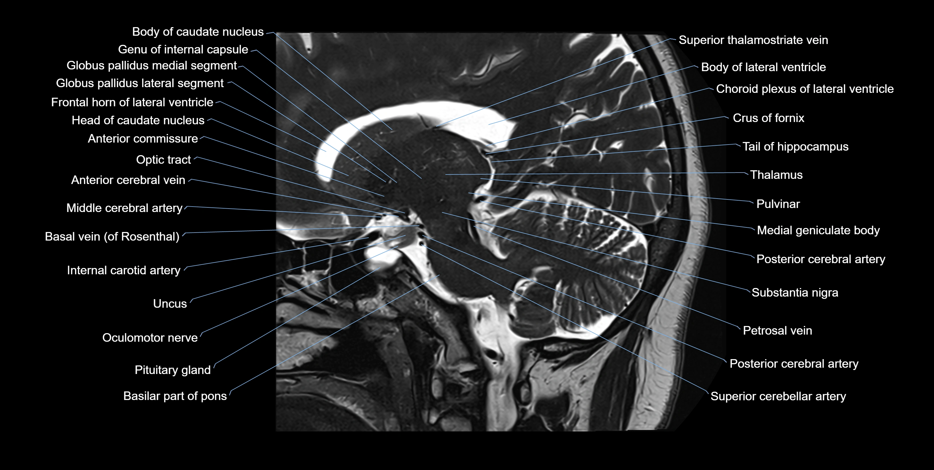 hippocampus sagittal cross sectional anatomy 3T MRI images -img-100012.webp